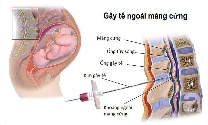 Phuong-phap-gay-te-ngoai-mang-cung-phu-hop-cho-ca-hinh-thuc-sinh-thuong-va-sinh-mo