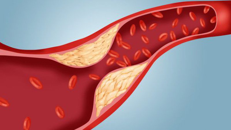 Mỡ máu cao ảnh hưởng lớn đến sức khỏe