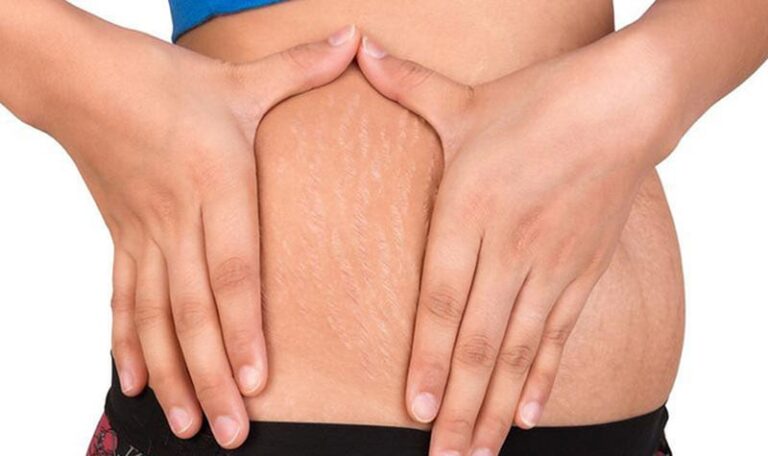 Cách trị rạn da sau sinh hiệu quả lấy lại làn da mịn màng