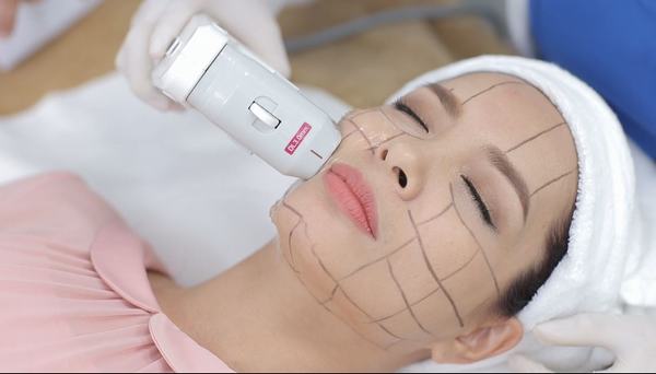 Quy trình nâng cơ mặt bằng HIFU chi tiết nhất