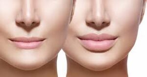 Tiêm filler môi có nguy hiểm không