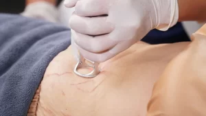 Xu hướng trị rạn da bằng công nghệ thẩm mỹ được nhiều người lựa chọn vì hiệu quả nhanh chóng