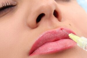 Để tiêm filler môi an toàn cần chú ý điều gì?