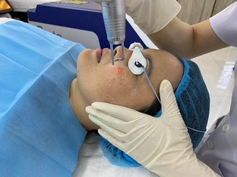 Trị nám da bằng công nghệ cao là gì và quy định điều trị thế nào?