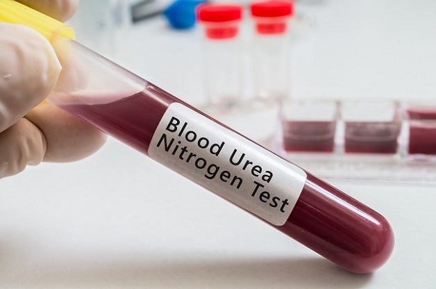 Xét nghiệm chỉ số Ure máu là gì và quy trình xét nghiệm máu