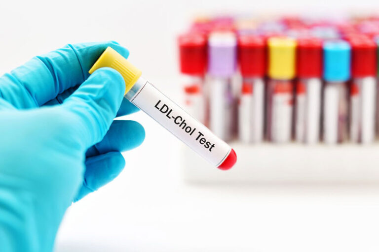 Những điều cần biết về chỉ số LDL là gì?